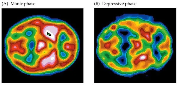 Мозговая активность при маниакальной и депрессивной фазе биполярного расстройства