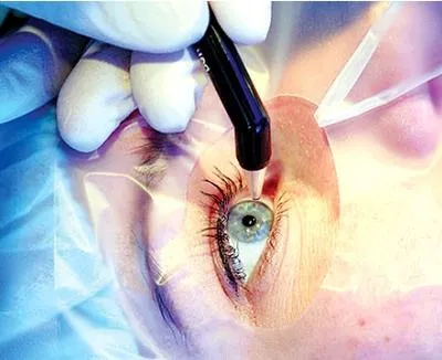 Операция на глазу