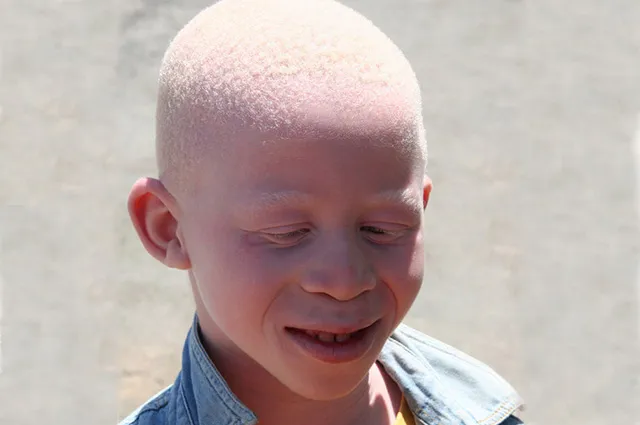 Мальчик-альбинос