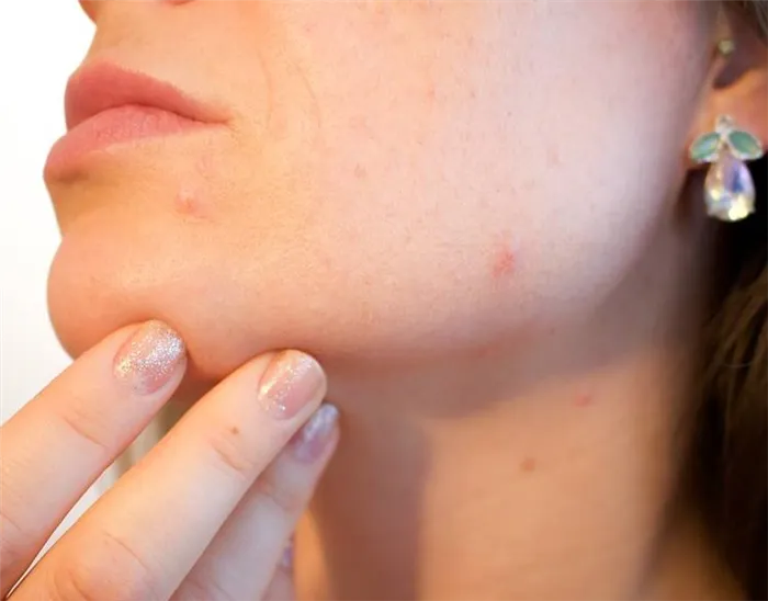 симптомы герпеса на губах