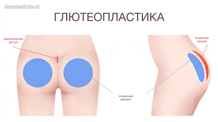 Глютеопластика - увеличение ягодиц при помощи имплантов