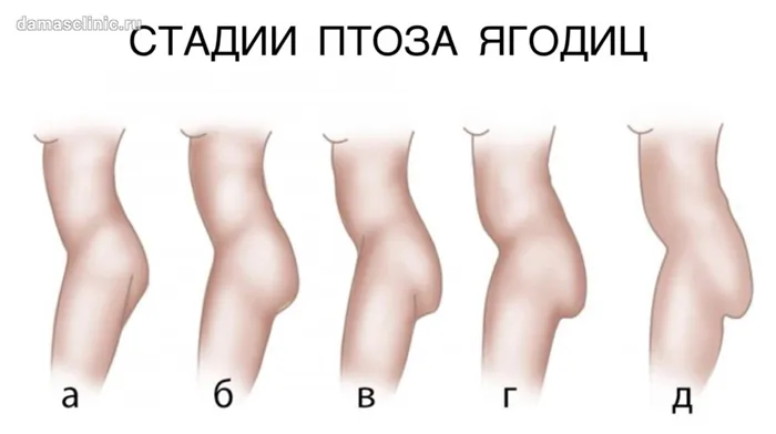 Стадии птоза ягодиц