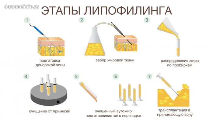 Как проводится липофилинг. Этапы процедуры