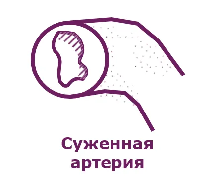 Суженная артерия