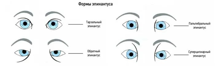 формы и виды эпикантуса